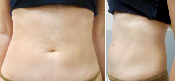 Um den Erfolg des Emsculpt zu dokumentieren, veröffentlichen wir hier die vorher-nachher-Bilder der Behandlung mit dem Emsculpt